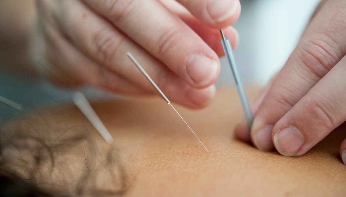 Acupuntura reduz efeitos colaterais da quimioterapia em pacientes