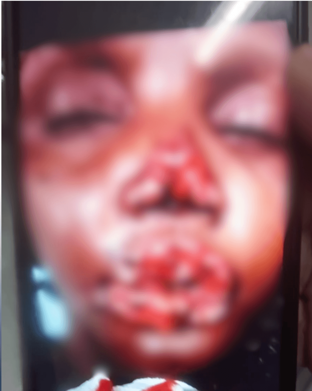 Mulher tem rosto desfigurado após ser mordida pelo companheiro