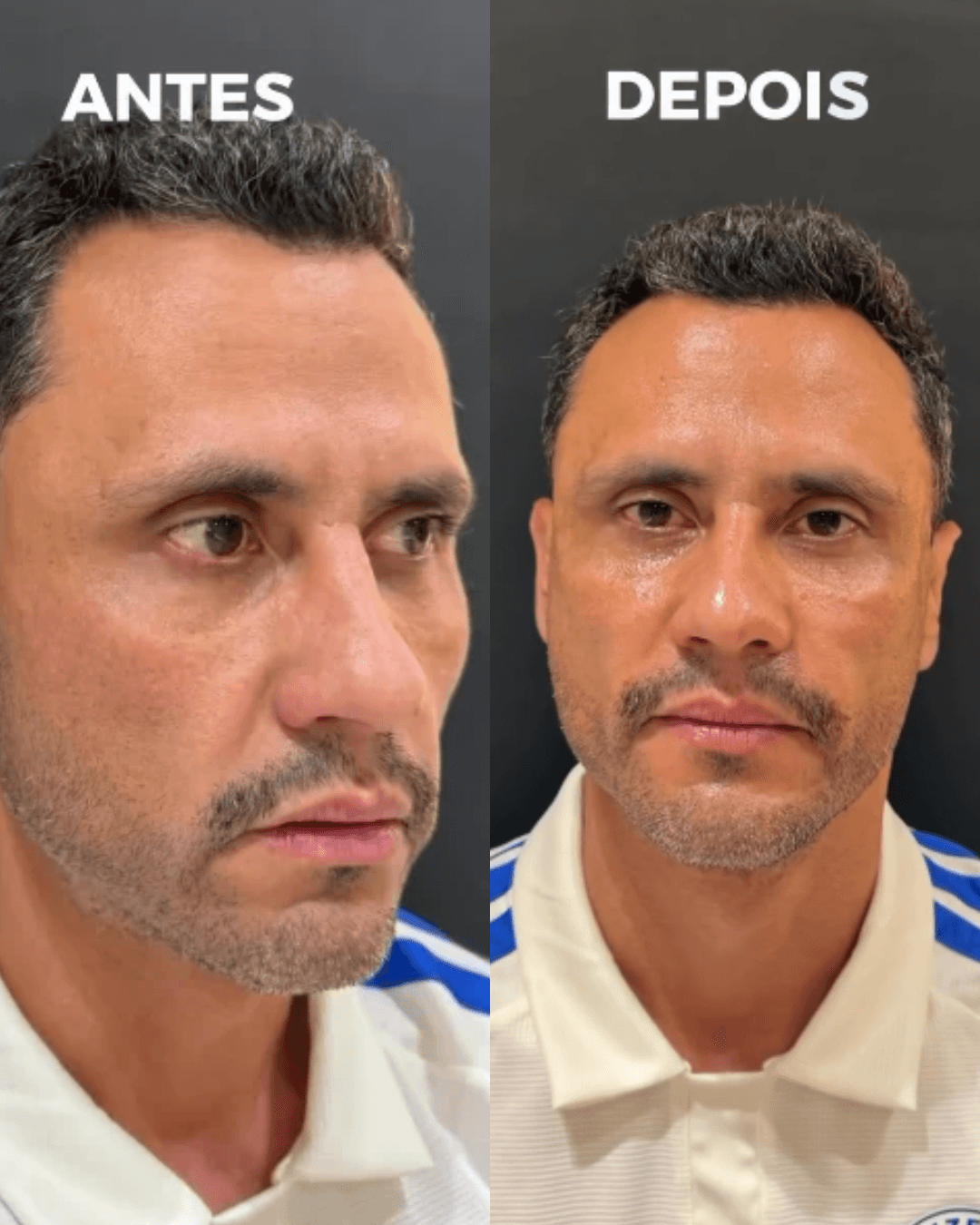 Após ser eleito governador, Cleitinho faz harmonização facial