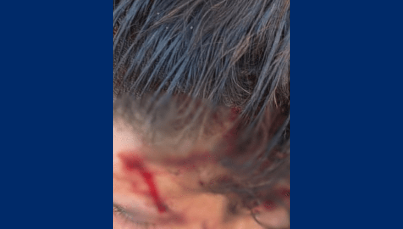 Mulher é intubada com hemorragia no crânio após ser agredida por 2 homens