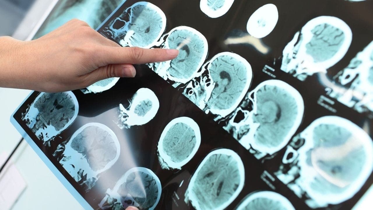 Buscas sobre Alzheimer disparam no Brasil e revelam angústia de quem cuida