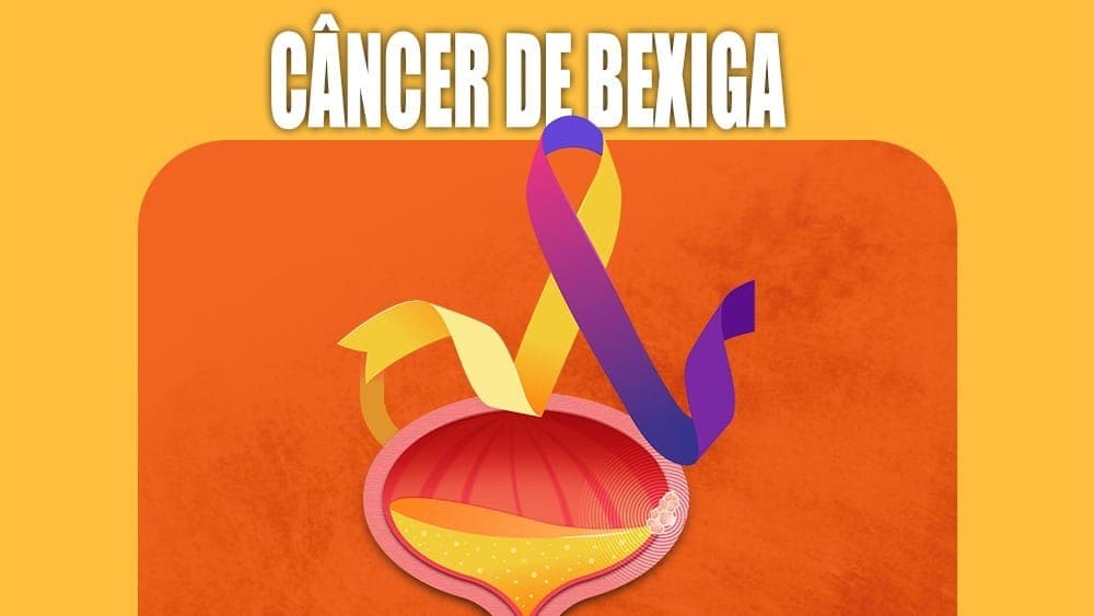 Combinação de remédios reduz risco de volta do câncer de bexiga e de morte