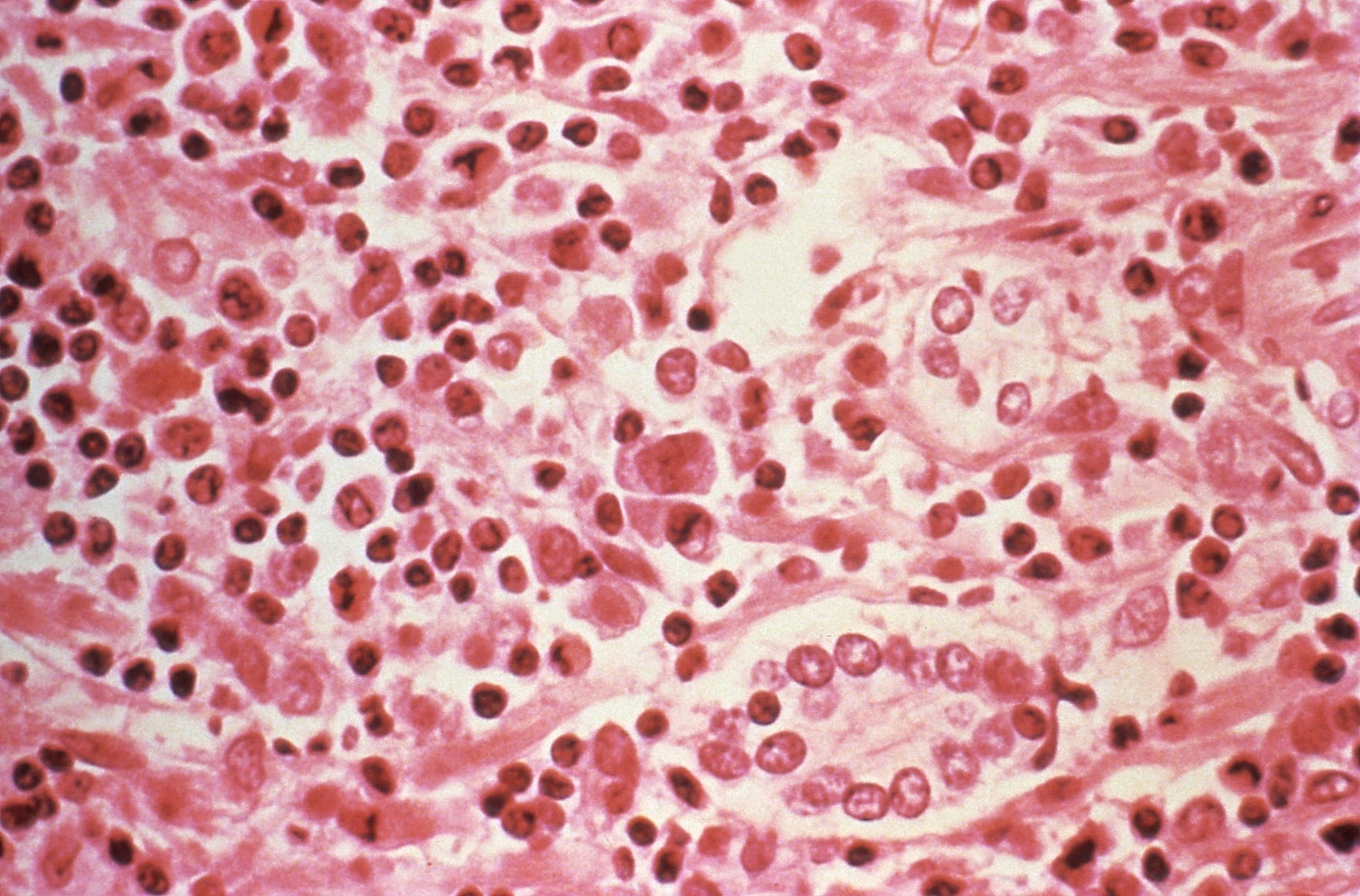 OMS espera novos casos de hantavírus, mas descarta pandemia