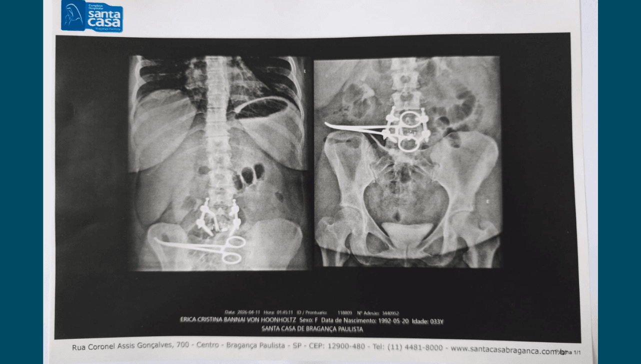 Paciente perde parte do intestino após pinça ser esquecida em cirurgia